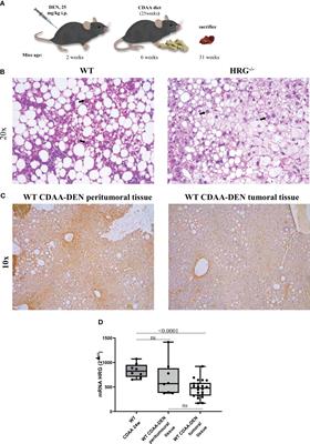 Histidine-rich glycoprotein in metabolic dysfunction-associated steatohepatitis-related disease progression and liver carcinogenesis